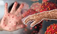mmch-measles-outbreak-children-hospitalized5808.jpg